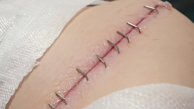 Close up view of skin with surgical staples, medical procedure leaving visible scar, bandaged skin near the wound, healthcare, treatment.