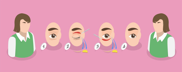 Fototapeta premium 3D Isometric Flat Vector Illustration of Eyelid Surgery Procedure, Removing Excess Skin Treatment