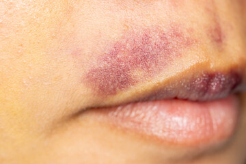 Background image of wounds caused by Systemic Lupus erythematosus (SLE) or Lupus.