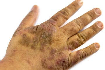 Background image of wounds caused by Systemic Lupus erythematosus (SLE) or Lupus.