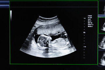 An ultrasound of a human fetus during the 16th week. Ultrasound of a child baby in the womb. Fetus...