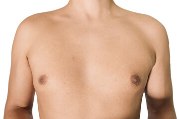 Fototapeta premium Cystic and hormonal acne on the chest of a man with a white background