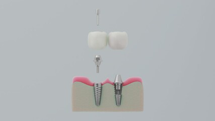 Dental Implant Comparison, Screw Retained vs Cement Retained