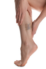 Woman with bruise on leg against white background, closeup