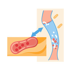 Varicose Veins Medical Illustration: Understanding the Venous Disease