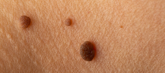 Multiple seborrheic keratoses growing on human skin