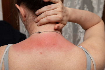 Woman suffering from sunburned skin touching neck