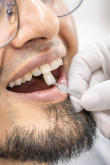 A dental professional uses a shade guide to match tooth color during a restoration procedure. Focus on precision and seamless blending