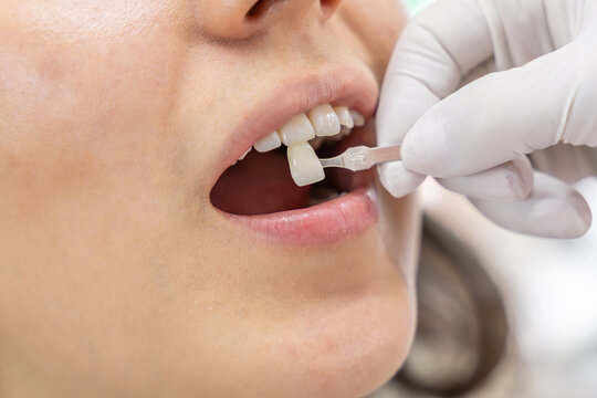 A dental professional uses a shade guide to match tooth color during a restoration procedure. Focus on precision and seamless blending