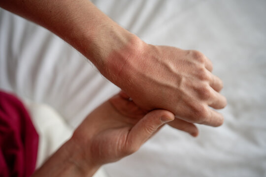 Man hand with sun burn left the mark on wrist watch. Male showing painful red skin on arm after sunburn, closeup. Summer season. 