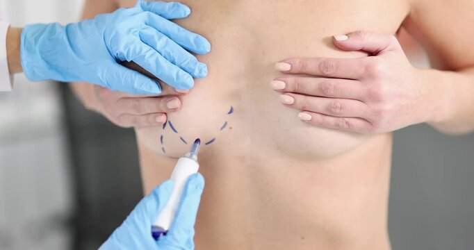 Doctor marks segments on patient bare breast for implant placing in clinic. Woman prepares for body parts augmentation with aesthetic surgery