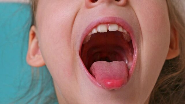 Close-up of little girl opening her mouth wide to the doctor to show her throat. Child is sitting with wide open mouth, with a tongue stuck out, clear view on the uvula and the soft palate. Footage 