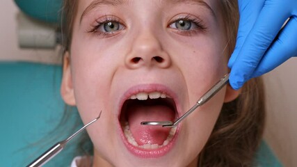 Close up dentist, doctor examines the oral cavity of a little girl, uses a mouth mirror, baby teeth close-up. Concept of pediatric dentistry, dental treatment. High quality motion footage