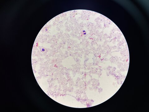gram negative bacilli in hemoculture.