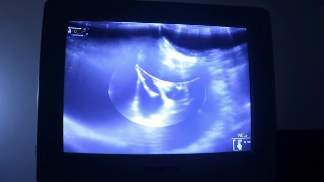 An ultrasound scan displays moving internal images on a monitor in a dark room. The screen flickers as the scan progresses, showing medical examination with copy space.