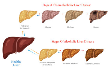 Diagram of Non Alcoholic and Alcoholic Liver Disease Stages Illustration