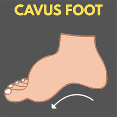 cavus foot or pes cavus deformity of foot high arch foot illustration useful for orthopedics diseases content