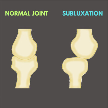 normal joint versus subluxation joint comparison illustration healthcare industry orthopedics