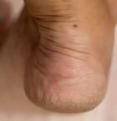 Fototapeta premium A person's foot with a small red spot on it