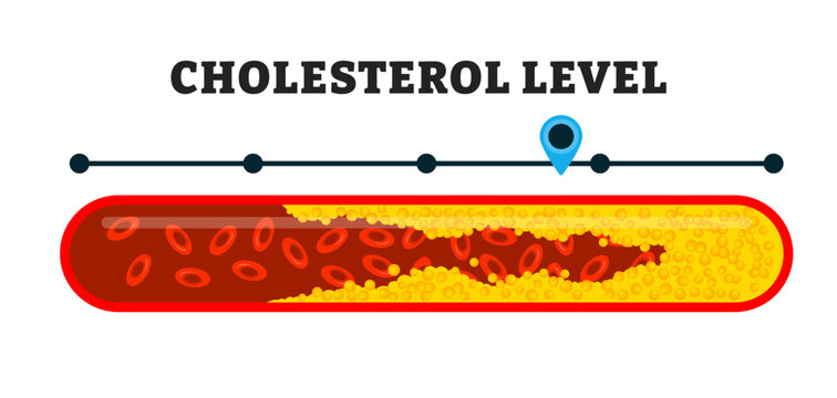 Cholesterol level on blocked blood vessel with arrow indicator medical diagram, educational medical poster design healthcare and heart health analysis scheme, labeled Cholesterol Meter or scale.