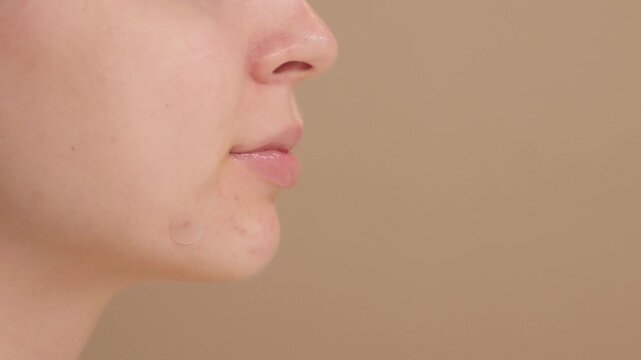 Close-up of a young woman applies a round acne patch to a blemish for spot treatment. Acne treatment, zit patch, acne spot patch ads. Young girl and smile in studio on beige background. Copy space.