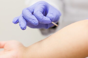 Doctor performing an allergy testing procedure by scratching the skin with a small needle in a...
