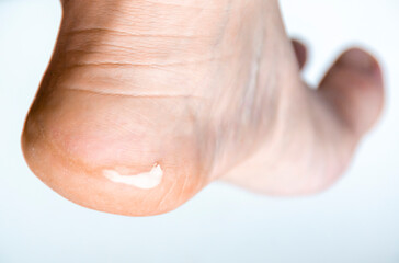 Large callus on a woman's heel. Close up of foot heel with callus