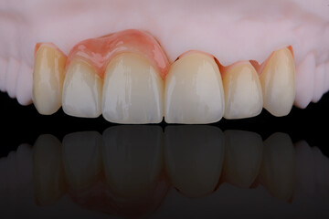 High-quality naturally dental single crowns made of zirconium for fixation to the frontal teeth of upper jaw. © gorynvd