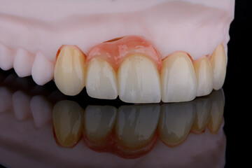 High-quality naturally dental single crowns made of zirconium for fixation to the frontal teeth of upper jaw. © gorynvd