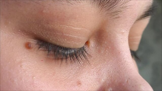 A brown convex mole near the eye. Nevus on the face close-up. Birthmarks. Eyes blink in close-up. 