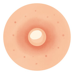 Types of Acne illustration 