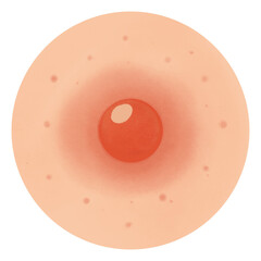 Types of Acne illustration 