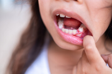 Close up of a child showing a mouth injury with redness on the gum. The child pulls down the lower...