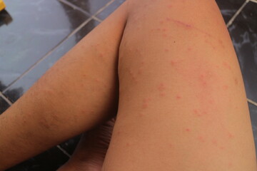 Mosquito Bite Rash on Human Skin