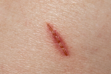 Healing wound showing scar tissue forming on skin