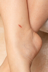 Fresh cut bleeding on woman's ankle showing skin damage