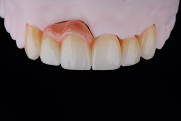 High-quality naturally dental single crowns made of zirconium for fixation to the frontal teeth of upper jaw. © gorynvd