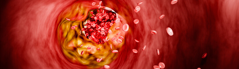 Unhealthy diet impact on blood vessels and heart health caused by cholesterol buildup, trans fats, processed food, increasing risks of heart attacks, strokes, and  chronic diseases. 3D rendering.
