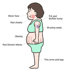 クッシング症候群の女性の側面、 特徴的な体型と症状