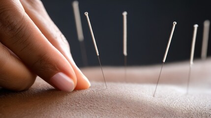 Close view of acupuncture needles being inserted into skin during a therapy session in a calm environment