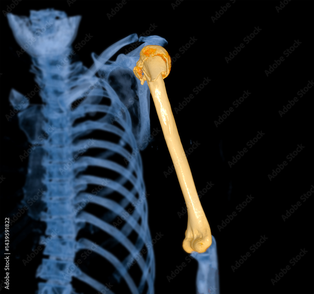 Poster ct scan 3d rendering of arm or humerus bone showing fracture head of humerus .