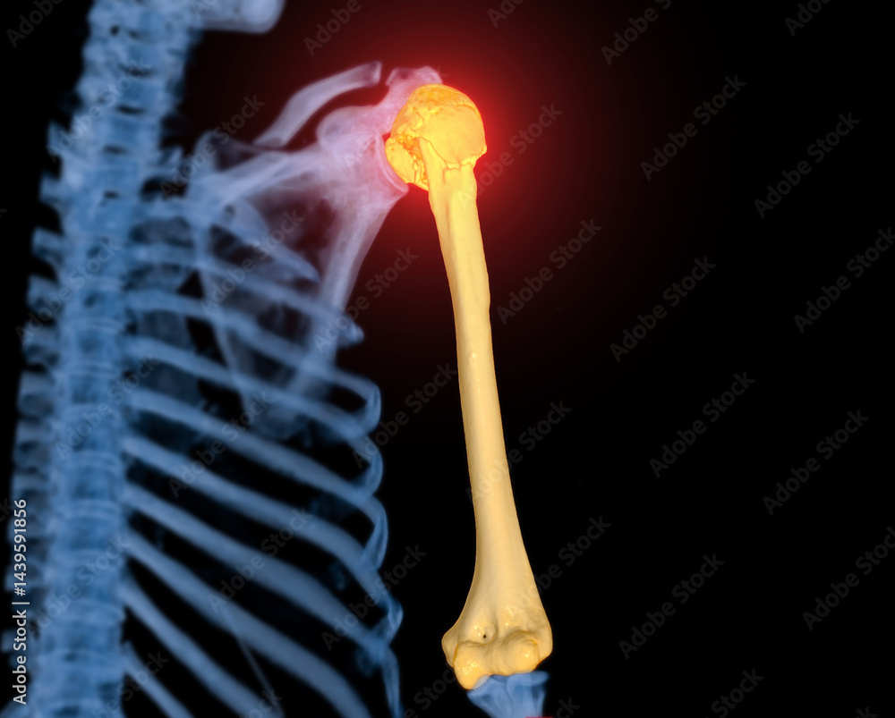 Poster ct scan 3d rendering of arm or humerus bone showing fracture head of humerus .
