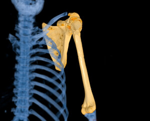 CT scan 3D rendering of  Arm or Humerus bone showing fracture head of humerus .
