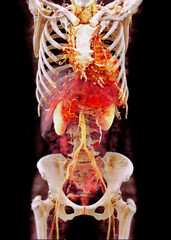 CTA Whole Aorta 3D showcases the aortic artery and its branches, offering a detailed look at the vascular.