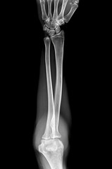 Before and After: Olecranon Fracture Treatment.