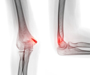 X-ray showing an elbow joint post-surgery with a fixation screw in place, highlighting the fracture site and inflammation in red.