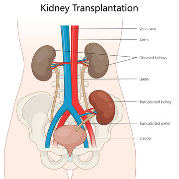 placement of a transplanted kidney and ureter in the human body alongside the diseased kidneys and major blood vessels diagram hand drawn schematic vector. Medical science educational illustration