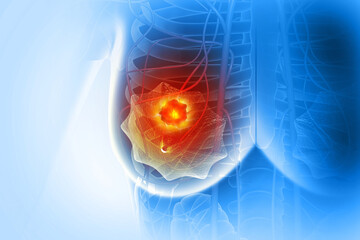 Breast cancer. Disease where abnormal cells in the breast grow out of control and form tumors. 3d illustration..