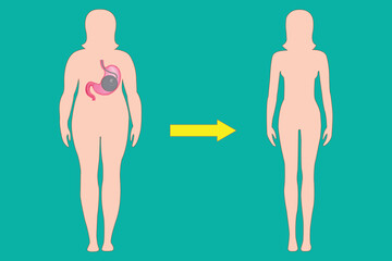 Weight loss concept with gastric balloon procedure illustration, before and after body transformation