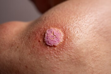 Fototapeta premium Close-up Image of Healing Skin Lesion with Scab and Redness on Human Skin Surface